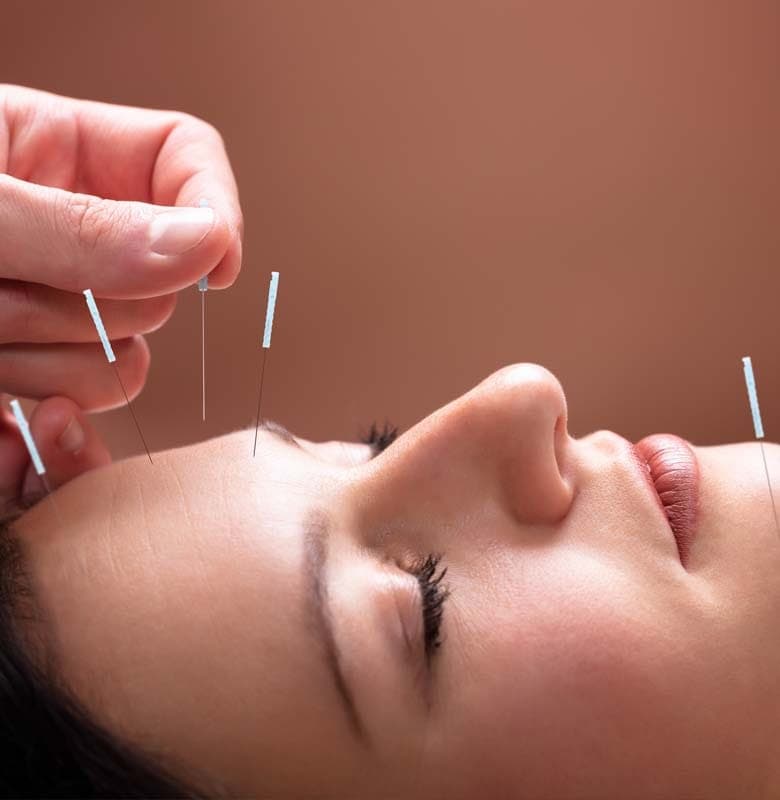 A practitioner's hand placing a fine acupuncture needle beside the eye of a woman lying with her eyes closed, other needles already in place