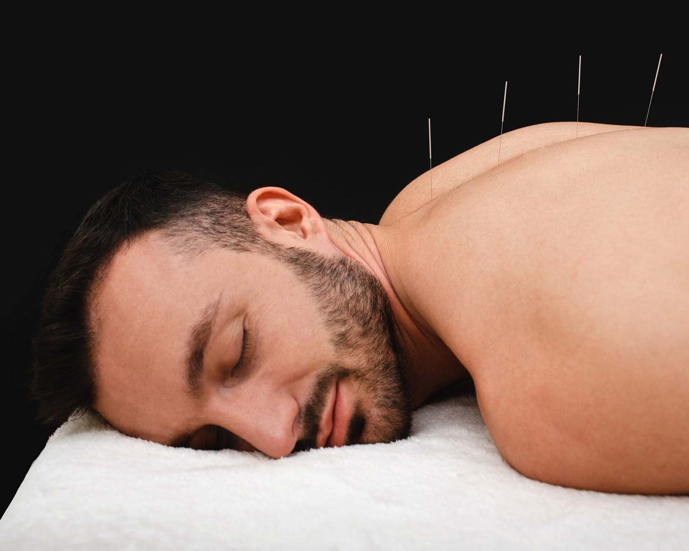A patient lying face down on a treatment table with fine acupuncture needles placed along the upper back.