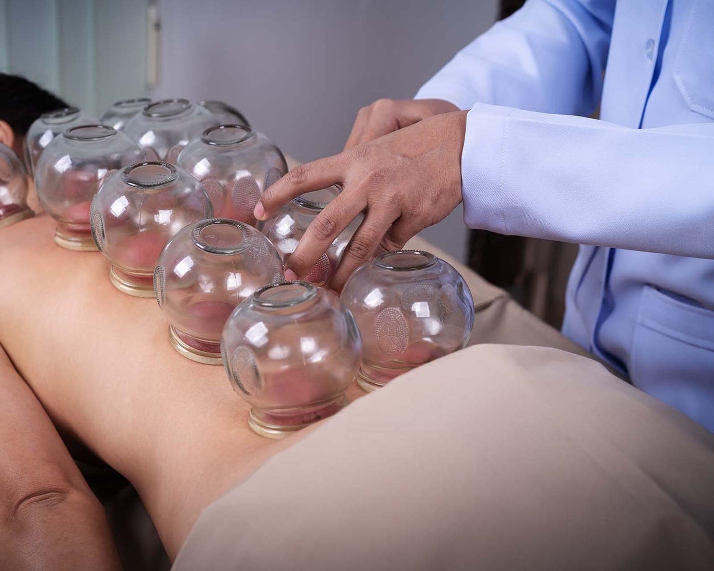 A practitioner placing rows of glass cupping jars along a patient's back.